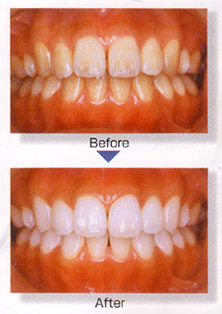 ホワイトニングbefore→after